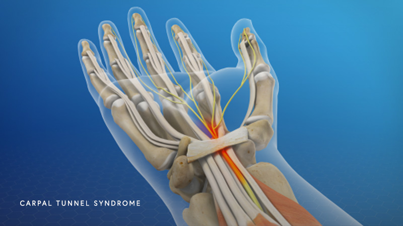 Carpal Tunnel Syndrome - Center for Orthopedic Specialists