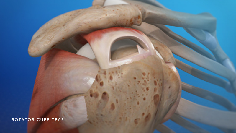 Rotator Cuff Tears Part II: What exactly is an Arthroscopic Rotator Cuff  Repair? : Orthopedic Center for Sports Medicine: Sports Medicine Physicians